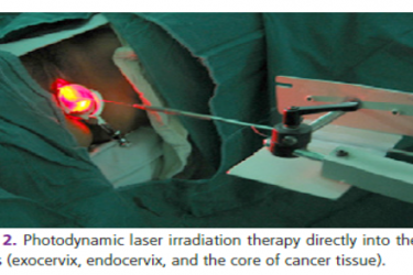 光动力疗法对宫颈癌的临床疗效的回顾性研究